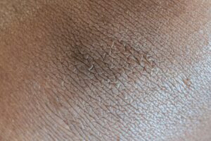 Textured background of skin surface with linear pattern and pigmentation spot in center